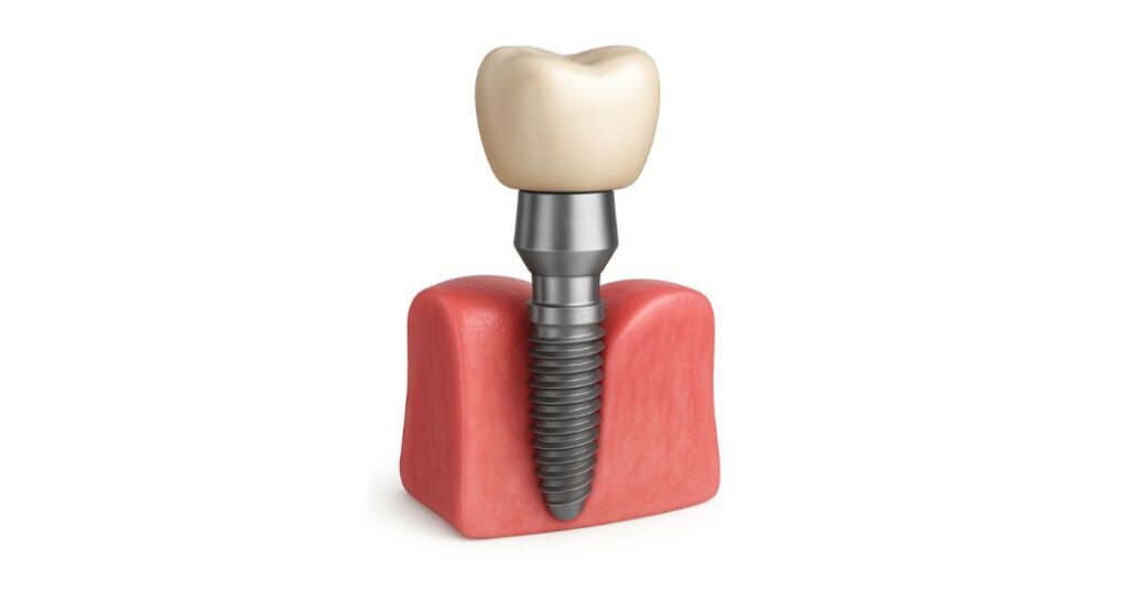 Implante Dentário na Cidade 2000 | Dentista em Fortaleza Implante Dental