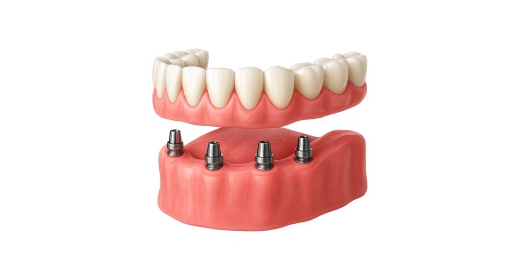 Implante Dentário na Cidade 2000 | Dentista em Fortaleza Protocolo Dentario