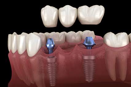 Implante Dentário na Cidade 2000 | Dentista em Fortaleza antes e depois implante dentario