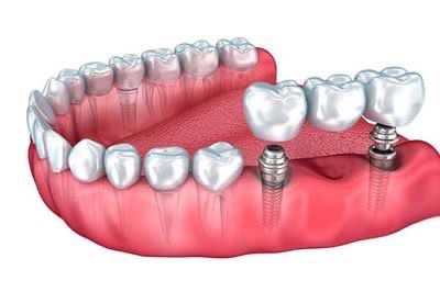 Implante Dentário na Cidade 2000 | Dentista em Fortaleza prótese fixa