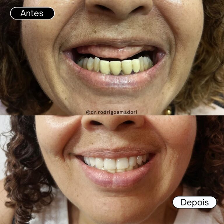 Implante Dentário na Cidade 2000 | Dentista em Fortaleza servico realizado implante dentario 1