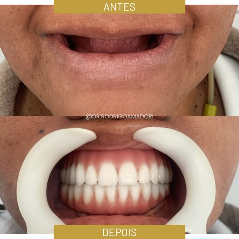 Implante Dentário na Cidade 2000 | Dentista em Fortaleza servico realizado implante dentario 2