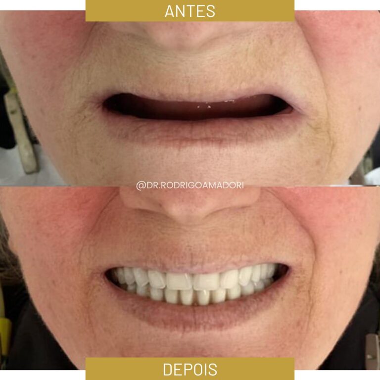 Implante Dentário na Cidade 2000 | Dentista em Fortaleza servico realizado implante dentario 3