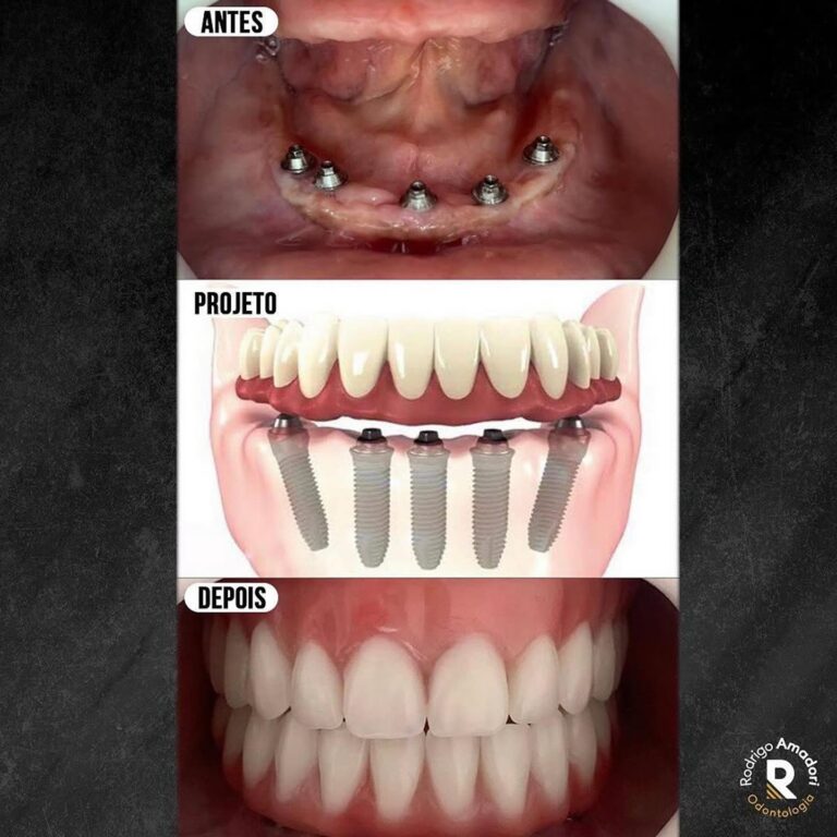 Implante Dentário na Cidade 2000 | Dentista em Fortaleza servico realizado implante dentario